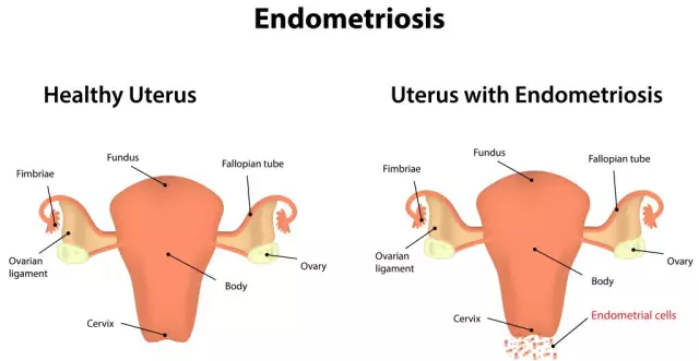 Endometriosis - Treatment, Symptoms, Signs