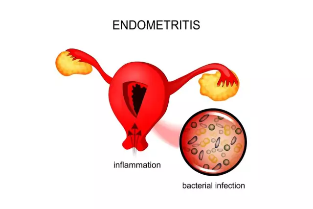 Endometritis - Treatment, Symptoms, Signs