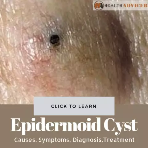 Epidermal Cyst - Causes, Symptoms, Treatment