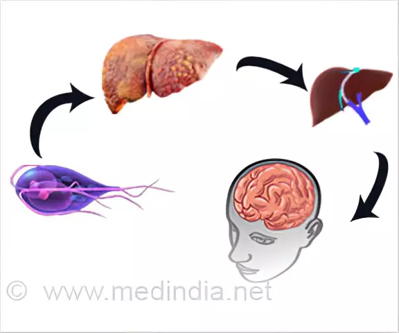 Encephalopathy - Types, Symptoms, Treatment