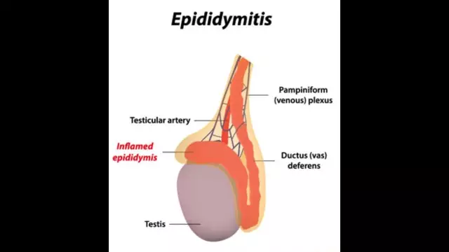 Chronic Epididymitis - Symptoms, Treatment, Causes