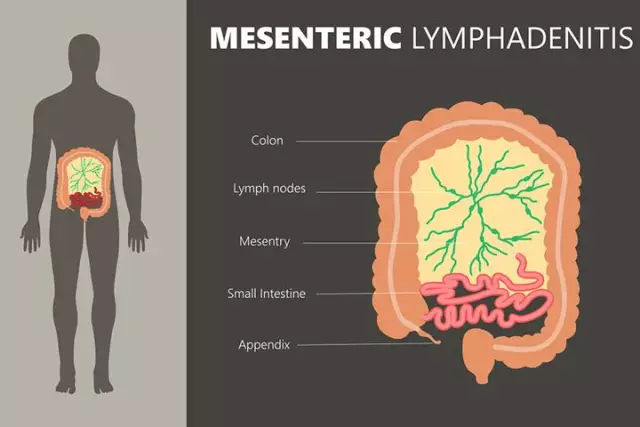 Cervical Lymphadenitis In Children, Adults - Causes, Treatment