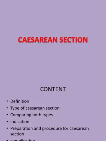 10 Myths About Caesarean Section