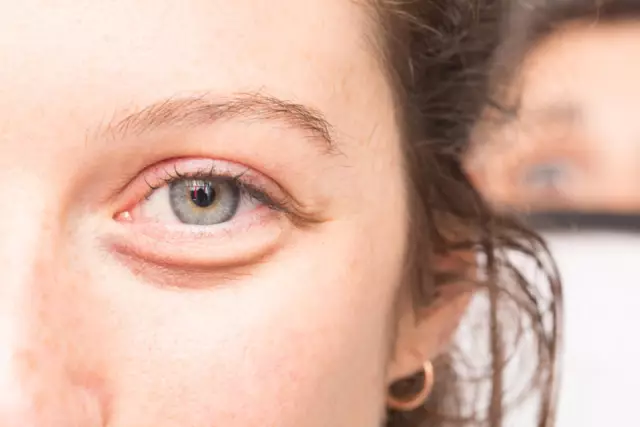 Bags Under The Eyes: 12 Causes Of The Problem