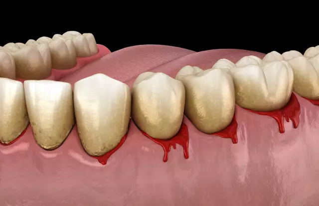 What To Do If Gums Are Bleeding?