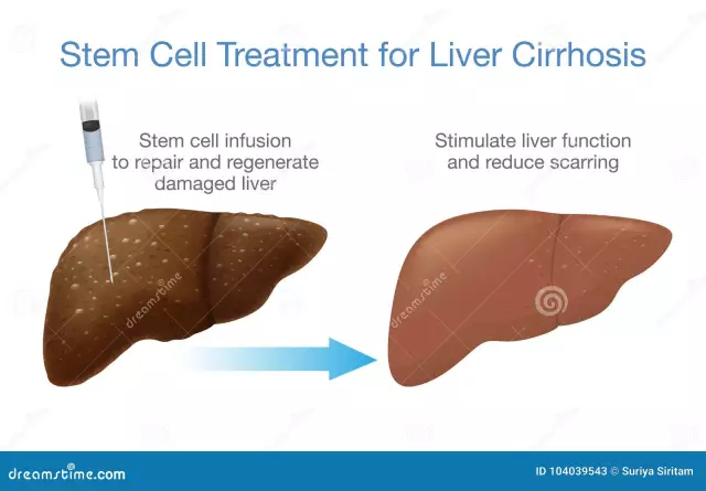 Stem Cell Treatment For Liver Cirrhosis