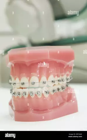 When Are Braces Placed On The Lower Jaw?