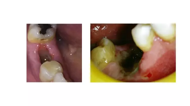 What To Do After Tooth Extraction?