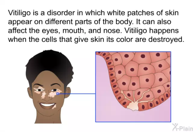 7 Misconceptions About Vitiligo