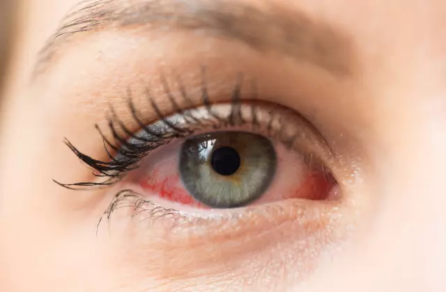 10 Causes Of Eye Redness