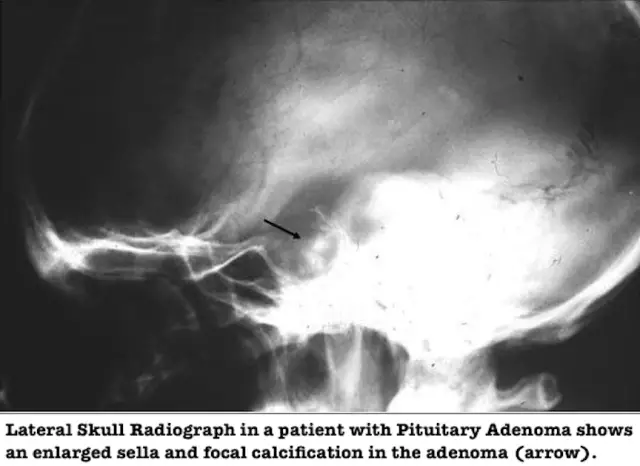 5 Myths About Pituitary Tumors