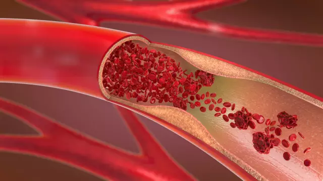 Deep Vein Thrombosis: 8 Signs Of Danger