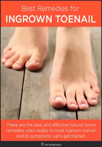 Ingrown Toenail: 10 Folk Remedies To Get Rid Of The Problem