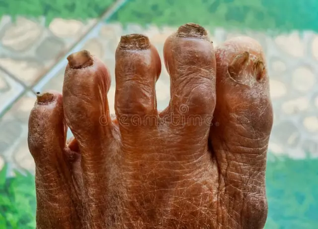 12 Common Foot Diseases