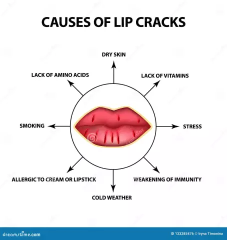 10 Causes Of Cracks In The Corners Of The Mouth