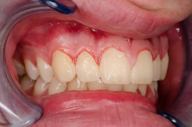 Plaque On Teeth: A Cosmetic Defect Or A Threat To Health?