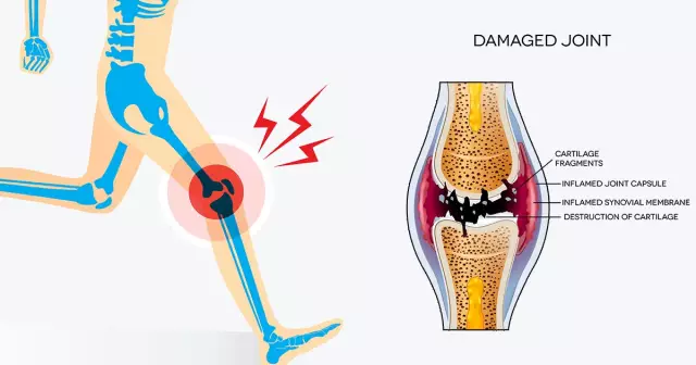 Causes Of Knee Pain