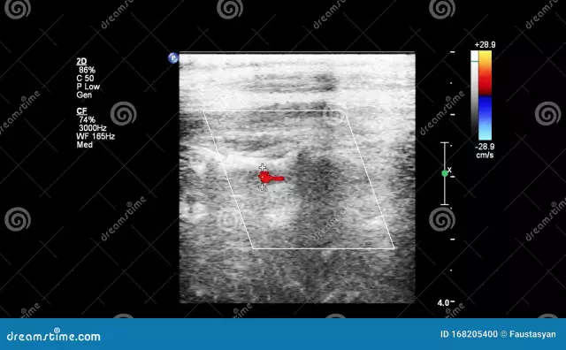 Why Do You Need Ultrasound Of Blood Vessels