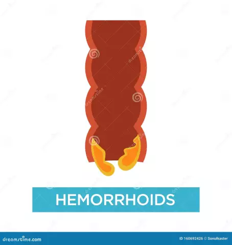 Internal Hemorrhoids: When Is It Time To Stop Being Shy And Go To The Proctologist