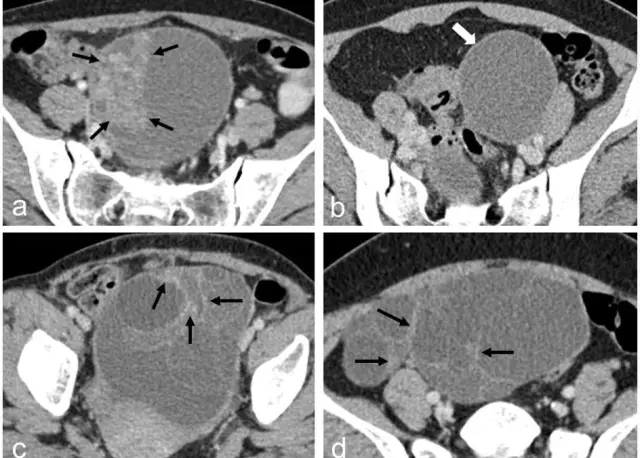 Wasted Ovarian Syndrome