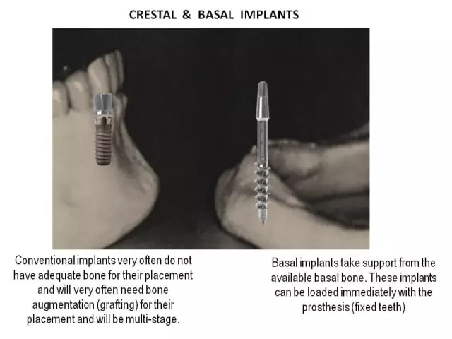 High-quality Basal Dental Implantation