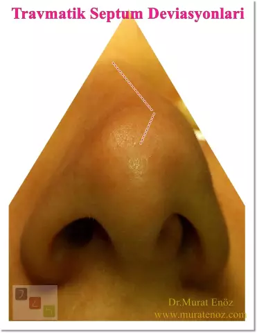 Curvature Of The Nasal Septum - An Invisible Danger To The Child