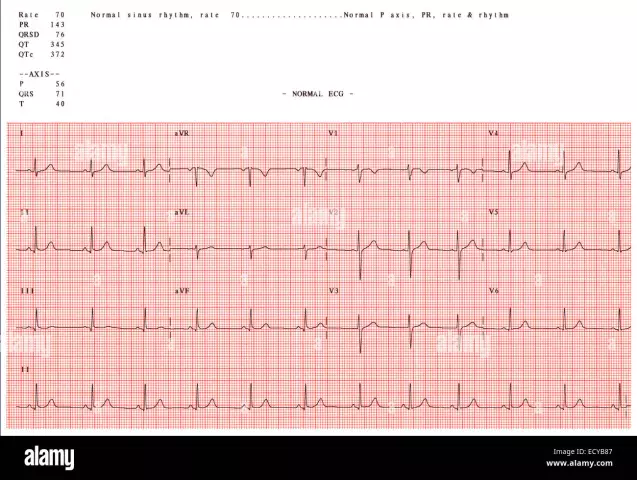 Electrocardiograma Para Tu Corazón