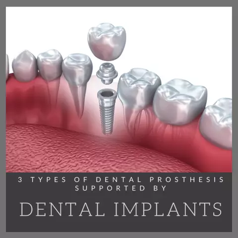 Types Of Dental Prosthetics