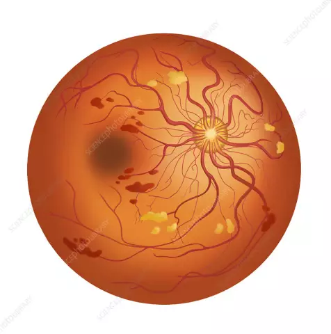 Retinal Disinsertion