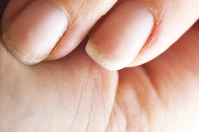 Why Nails Exfoliate - The Main Reasons, Risk Factors, Treatment Methods