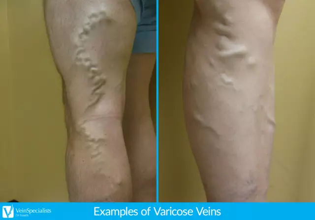 Varicose Veins On The Legs - Causes, Symptoms, Prevention