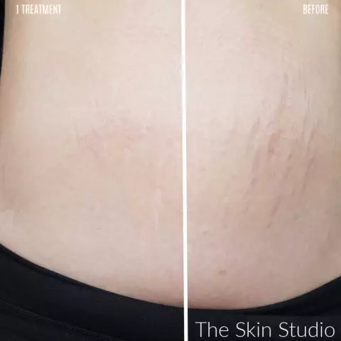 Stretch Marks On The Skin - What To Do?