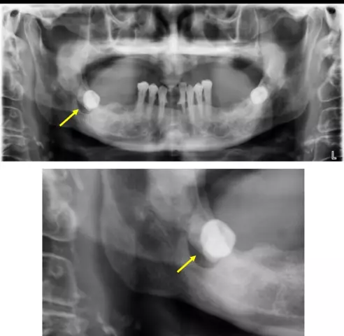 Cyst At The Root Of The Tooth - Causes, Symptoms, Treatment