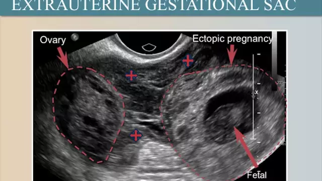 Signs Of An Ectopic Pregnancy