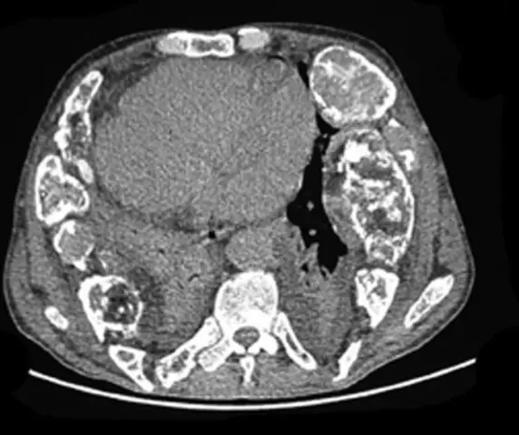 Treatment Of Fibrous Mastopathy