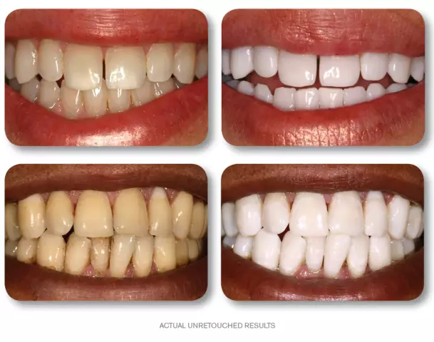 Teeth Whitening