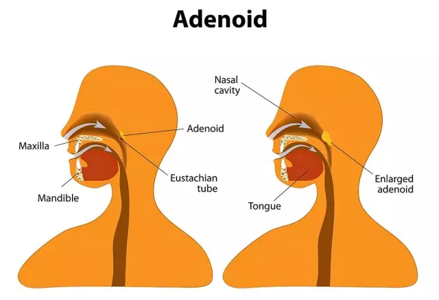 Treatment Of Adenoids In Children