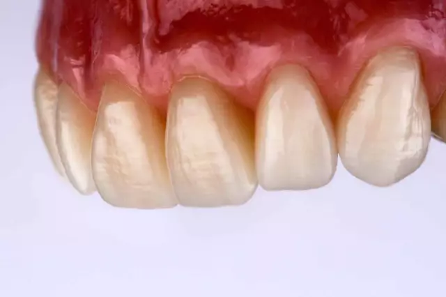 Dental Prosthetics Or Implantation?