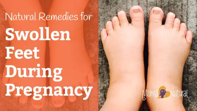 Swelling During Pregnancy