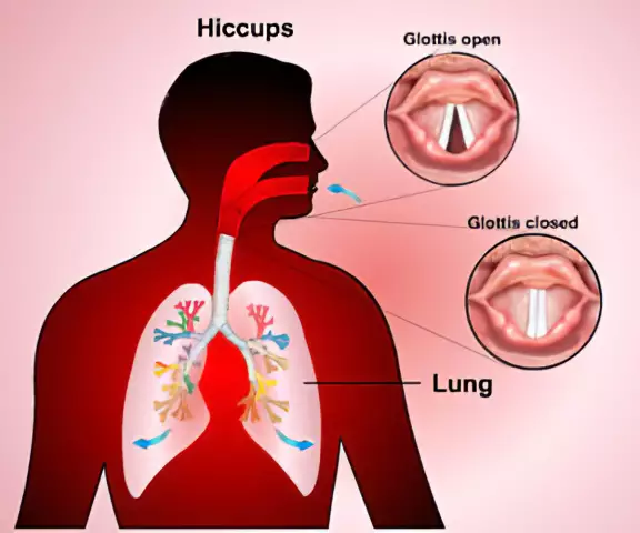 How To Get Rid Of Hiccups