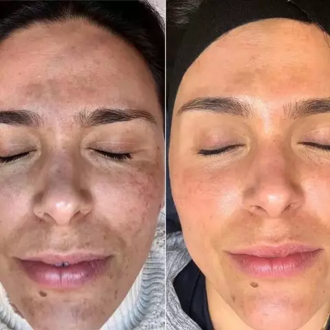 Chemical Peeling Of Facial Skin