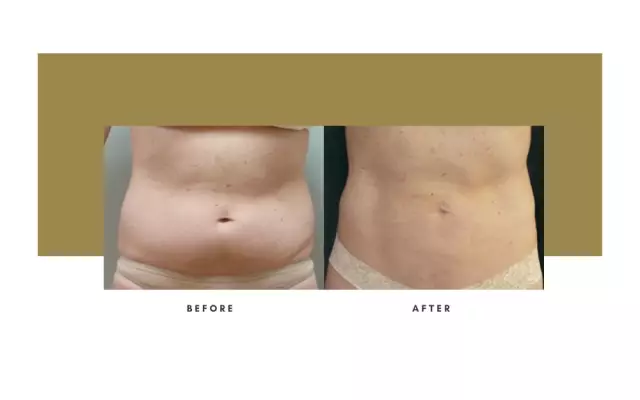 Ultrasonic Liposuction