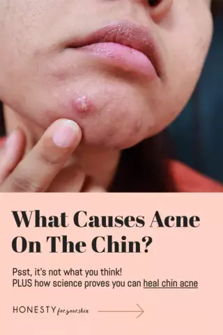 The Causes Of Acne