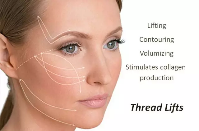 Thread Lifting - Indications, Benefits, Effectiveness