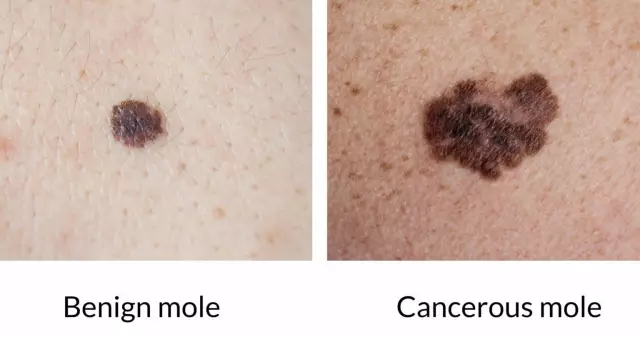 Dangerous Mole - Symptoms