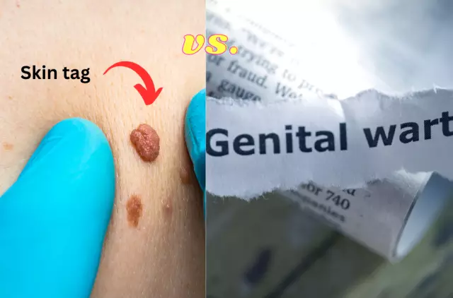 New Treatment Options For Genital Warts