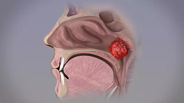 Not Just A Runny Nose: What Is Adenoiditis, Why It Occurs, How To Treat It