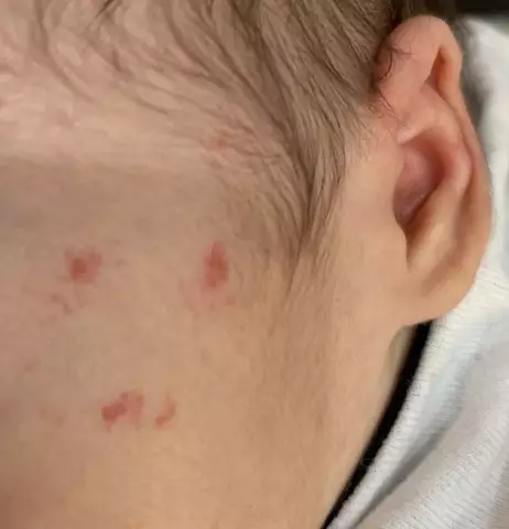 Red Spots On The Face In Adults And Children - Causes, Treatment