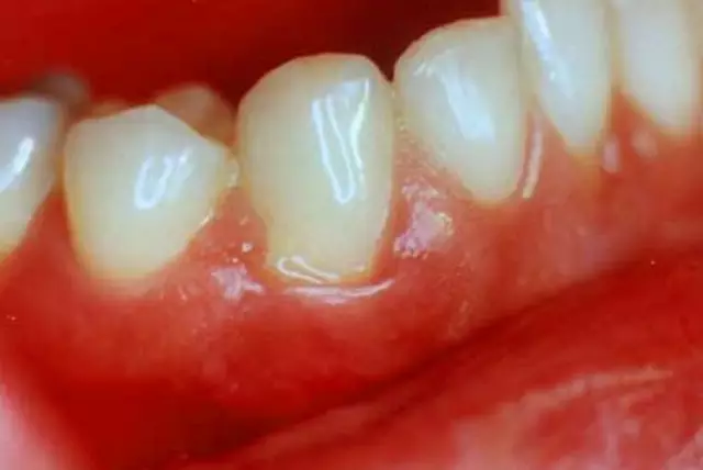 Swollen Gums