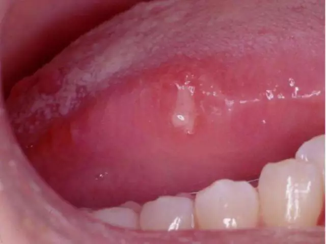 Why The Tongue Hurts - Reasons, Clinical Picture